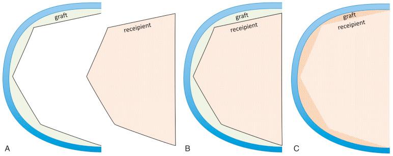 Fig. 73.4, Fresh large osteochondral shell allograft transplantation (FLOCSAT) principle. (A) Schematic representation of a tailored FLOCSAT with complex-shaped geometry (e.g., distal femur; graft; left ) and the complementarily configured recipient (right). (B) Attached FLOCSAT on the host. (C) After osteointegration of the FLOCSAT.