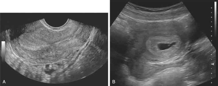 FIG 38-1, A, Transvaginal sonogram obtained at approximately 4.5 weeks demonstrating no evidence of an intrauterine pregnancy. Additional scans revealed normal ovaries without evidence of an adnexal mass. B, Transabdominal sonogram obtained 1.5 weeks later revealed a living intrauterine pregnancy.