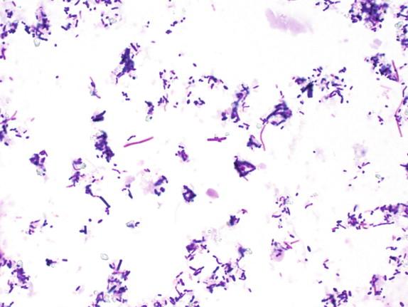 Figure 29-1, Appendix, mixed gram-positive and negative cocci and bacilli on tissue Gram stain. Brown and Brenn stain, 1000 × magnification.