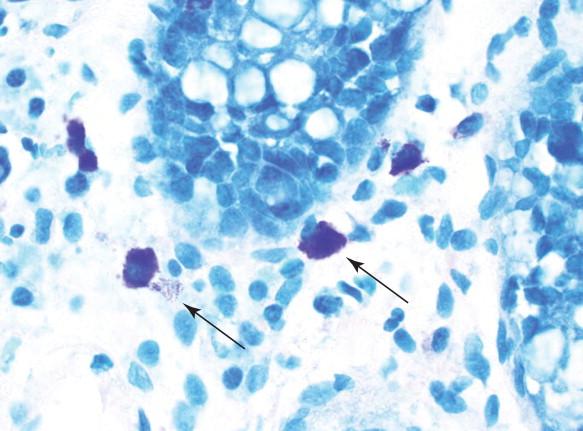 Figure 29-11, Mast cells. The granules stain a red-purple with acid-fast stains and should not be confused with true acid-fast organisms (arrows, Ziehl-Neelsen stain, 1000 × magnification).