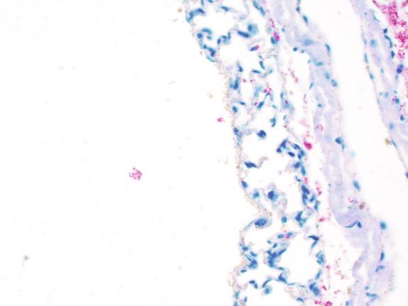 Figure 29-12, This strongly positive control containing Mycobacterium avium complex had contaminated the patient tissue section that was also mounted on the same slide; clumps of AFB were observed in the region around the positive control and extended into the region of the slide where the patient specimen was mounted.