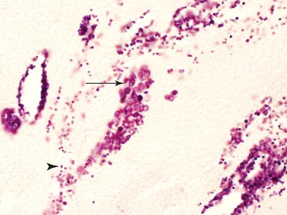 Figure 29-14, Heart valve showing gram-positive cocci (Brown and Brenn stain, 1000 × magnification) in a patient who received antibiotics prior to surgery. Although most cocci are of the expected size (arrowhead), some markedly enlarged forms are also present (arrow).