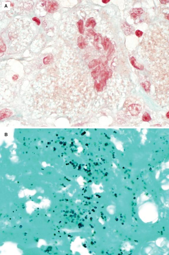 Figure 29-15, Heart valve from a patient who was treated with antibiotics prior to surgery. On tissue Gram stain ( A, 1000 × magnification), the bacteria fail to stain as expected and are only faintly apparent as negative outlines associated with a multinucleated giant cell. Fortunately, GMS clearly highlights the outer contours of the cocci ( B, 1000 × magnification) and was essential for identifying the organisms in this case. Corresponding valvular tissue cultures and multiple blood cultures grew Staphylococcus epidermidis .