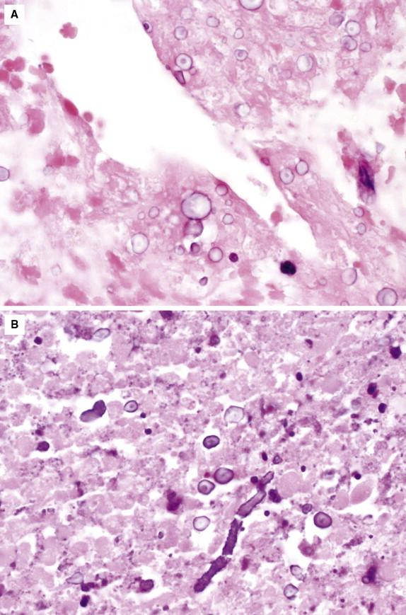 Figure 29-16, Calcifications typically have a basophilic appearance on H&E and may resemble budding yeasts (A) or hyphae (B) . Note the irregular contours and fragmented nature of some of the forms. H&E stain, 400 × magnification.