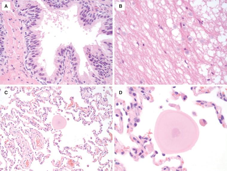 Figure 29-17, Corpora amylacea are commonly seen within benign glands in the prostate (A) but may also be seen in malignant glands of prostatic adenocarcinoma, the brain (B) , and within alveoli in the lung ( C and D ).