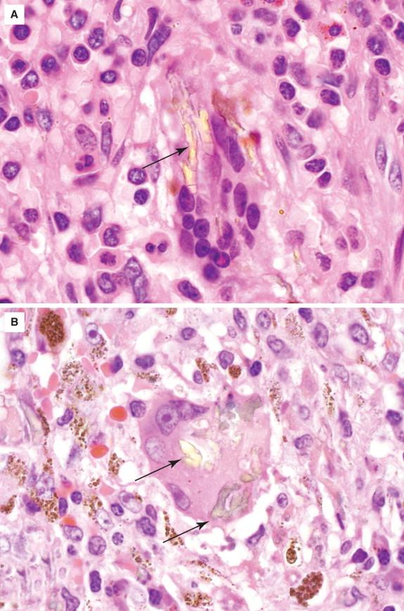 Figure 29-18, Characteristic appearance of Gamna-Gandy bodies (arrows) demonstrating a yellow-brown color with foreign body giant cell reaction and abundant associated hemosiderin pigment (H&E stain, 400 × magnification). Note the elongated structure (A) resembling a fungal hypha with septations.