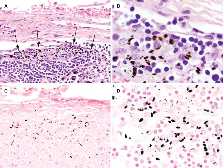 Figure 29-19, Hamazaki-Wesenberg bodies in a mesenteric lymph node from a patient who underwent colon resection due to adenocarcinoma. They are typically in or near the lymph node sinuses ( A, arrows, 400 × magnification) and have a distinct brown-black color on H&E ( B, 1000 × magnification). They are easily seen on GMS ( C, 400 × magnification) and stain deep black with the Fontana-Masson stain ( D, 1000 × magnification). Note the oval to fusiform shape and significant variation in size.