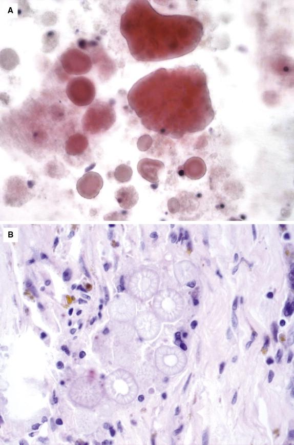 Figure 29-20, Liesegang rings from an aspirated breast cyst ( A, Pap stain, 200 × magnification). Similar features with an external layer and radial striations are seen on H&E ( B, kidney, 200 × magnification) and PAS.