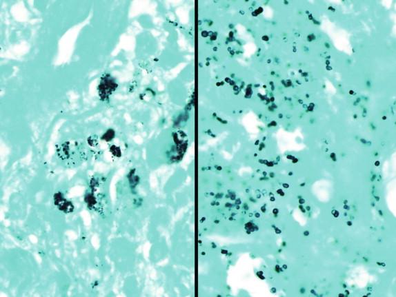 Figure 29-2, GMS is a nonspecific stain that may highlight a variety of noninfectious structures such as melanin granules (left) in addition to microorganisms like bacteria (right) and fungi. Unlike true organisms, noninfectious material is typically pleomorphic in size and shape and has irregular contours, whereas organisms typically have smooth external contours and most have a relatively consistent size.