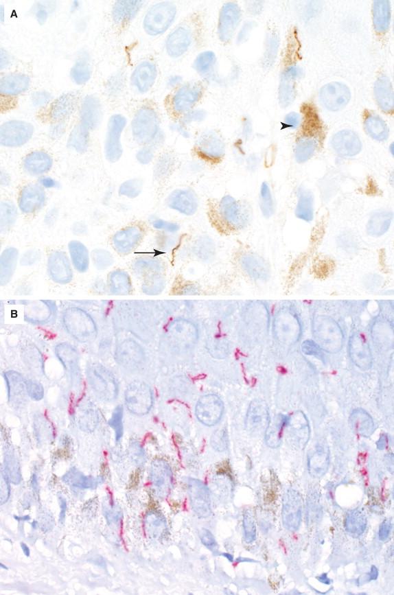 Figure 29-3, Skin demonstrating melanin and syphilis spirochetes (1000 × magnification, immunohistochemical stains for Treponema pallidum ). Melanin is seen as a granular brown pigment cap over keratinocytes (A, arrowhead), whereas the spirochetes are seen as distinct wavy bacilli (arrow). To avoid potential confusion between immunohistochemical dyes and melanin pigment, particularly in the skin, a red reporter dye can be used instead of a brown dye so that the red treponemes are clearly differentiated from the brown melanin pigment (B).