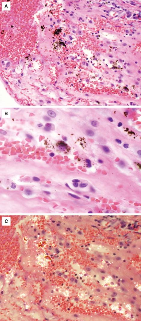 Figure 29-5, Formalin pigment shown at 200 × magnification (A) and 400 × magnification (B) (H&E stain). Note the precipitated clumps of brown-black pigment. The granules have jagged, irregular contours in contrast with bacteria that have generally smooth, well-defined contours and are basophilic on H&E. Formalin pigment is moderately birefringent on polarized light ( C, H&E stain, 200 × magnification).