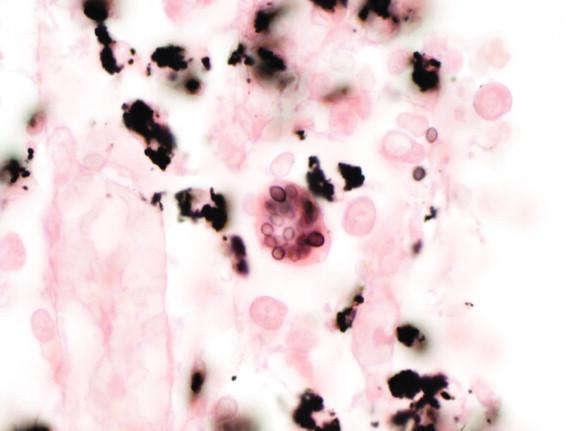 Figure 29-6, Histiocytes containing yeasts of Histoplasma capsulatum are difficult to identify among heavy deposition of carbonaceous pigment in this paratracheal lymph node, even when viewed at 1000 × magnification (GMS stain).