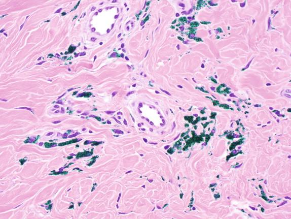 Figure 29-7, Blue-green tattoo pigment within dermal histiocytes. H&E stain, 400 × magnification.