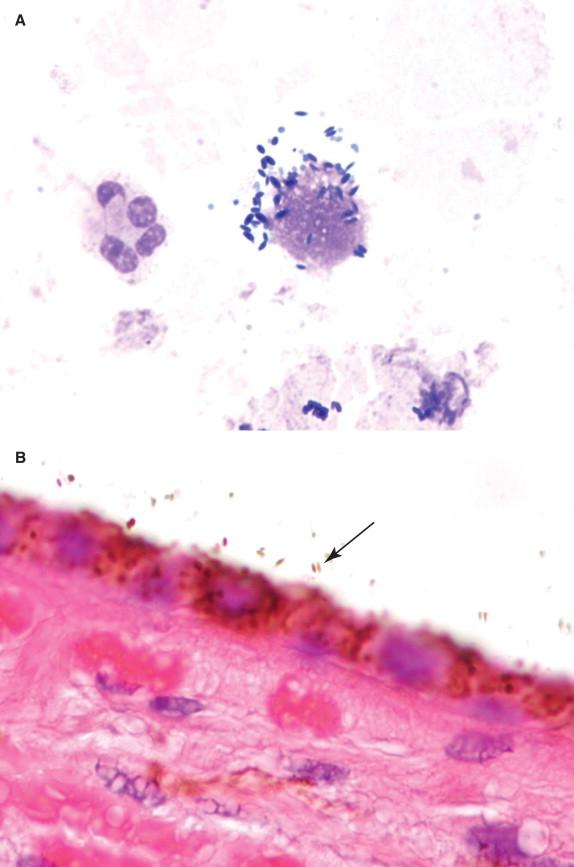 Figure 29-8, Phagocytosed melanosomes within a macrophage in a cytospin preparation of aspirated vitreous fluid ( A, May-Grünwald-Giemsa stain, 1000 × magnification). Note the deep blue color, spindled shape, and tapered ends of the melanosomes. In states of inflammation or malignancy that disrupt the retinal pigmented epithelium, melanosomes may be released into vitreous fluid (arrow) ( B, H&E stain, 400 × magnification).