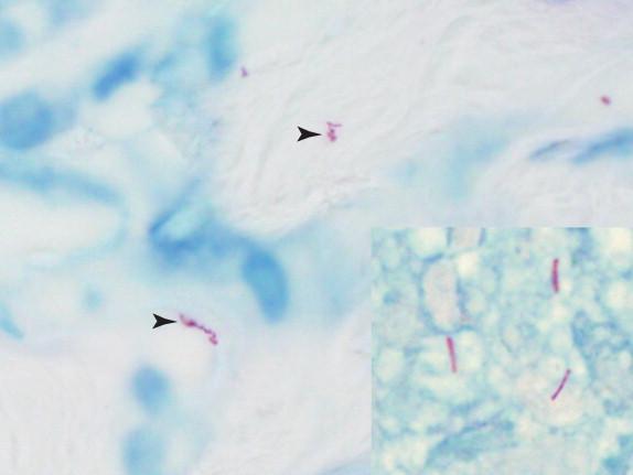 Figure 29-10, Carbol-fuchsin stain precipitate is occasionally seen on acid-fast-stained slides and may mimic acid-fast bacilli. Precipitated stain can usually be differentiated from true bacilli by its irregular borders (arrowhead ) and variation in size and shape (Ziehl-Neelsen stain, 1000 × magnification). A bacillus of Mycobacterium tuberculosis is shown for comparison (inset, 1000 × magnification).