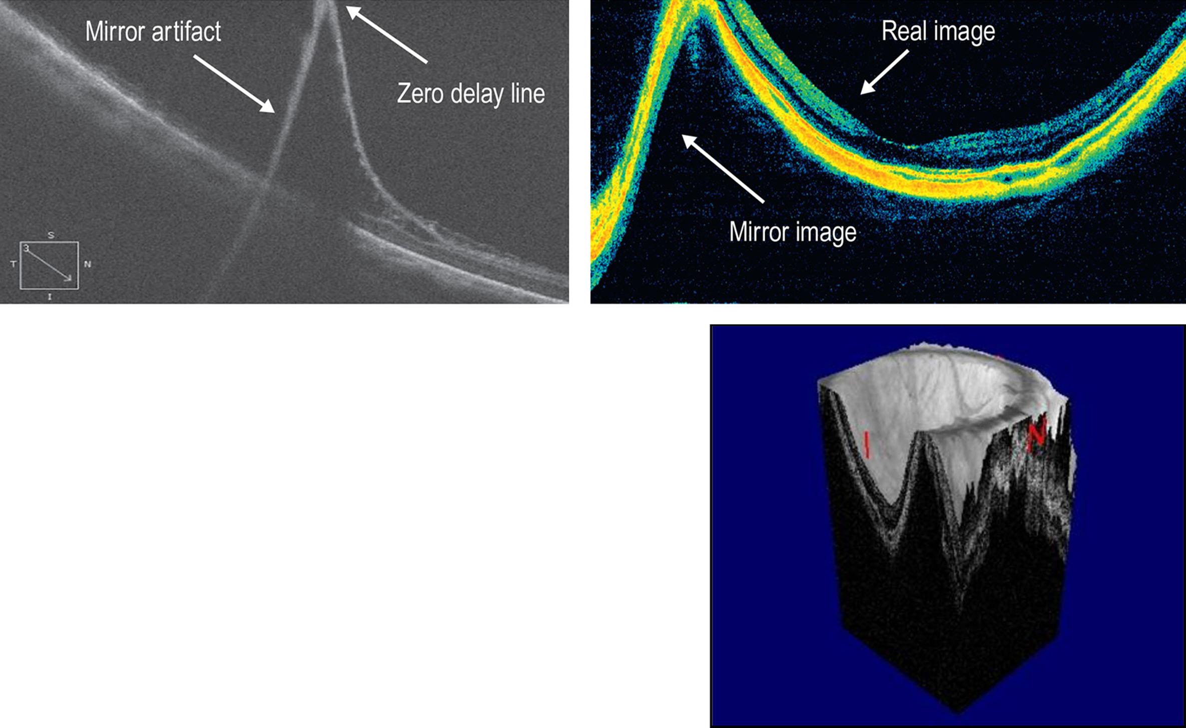 Figure 3.1.1, Shows mirror artifact in retinoschisis. The scanner is focused on the vitreoretinal surface at the site of the attached retina and the anteriorly projecting retinoschisis crosses the zero delay line giving a mirror image. The arrows point at the ghost image and the position of the zero delay line. The second image shows mirroring in a highly myopic eye with a long axial length. 3D reconstruction shows increased axial elongation of the highly myopic eye.