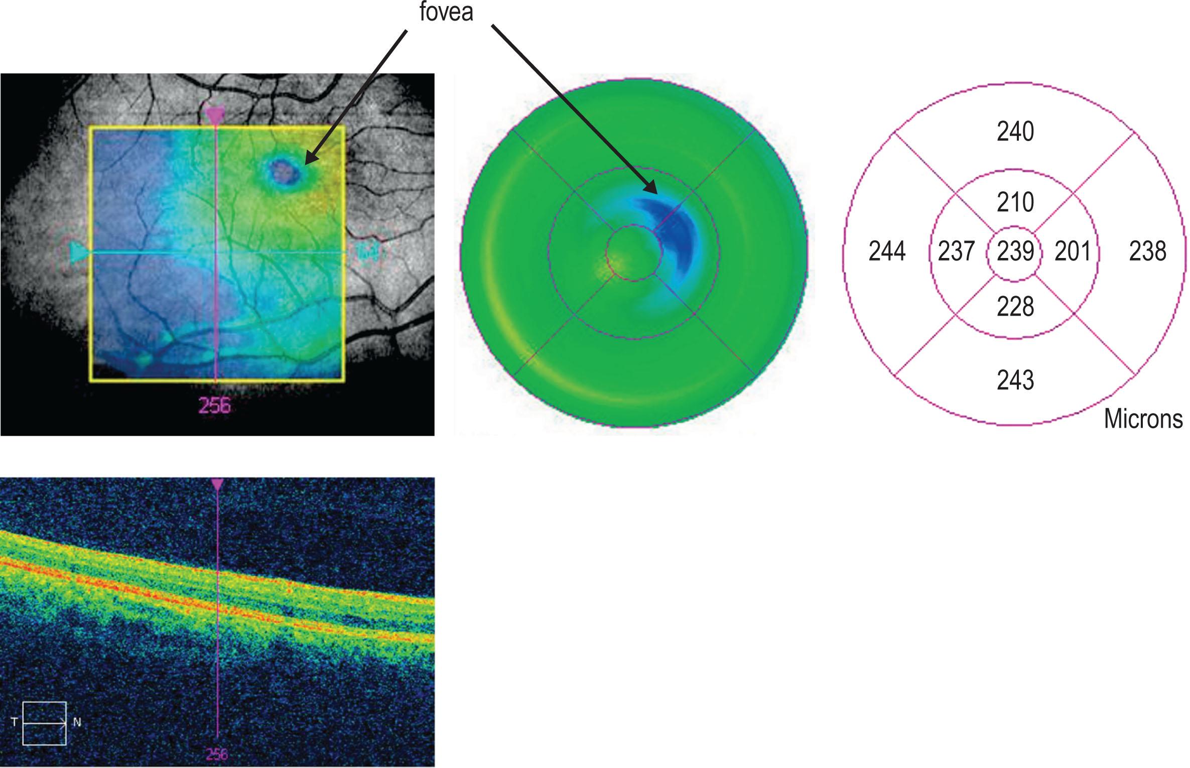 Figure 3.1.3, The macular map shows the thinnest part of the macula eccentric to the center of the Early Treatment Diabetic Retinopathy Study grid and the rendered fundus image. Note the absence of the foveal pit in the center of the line scan.