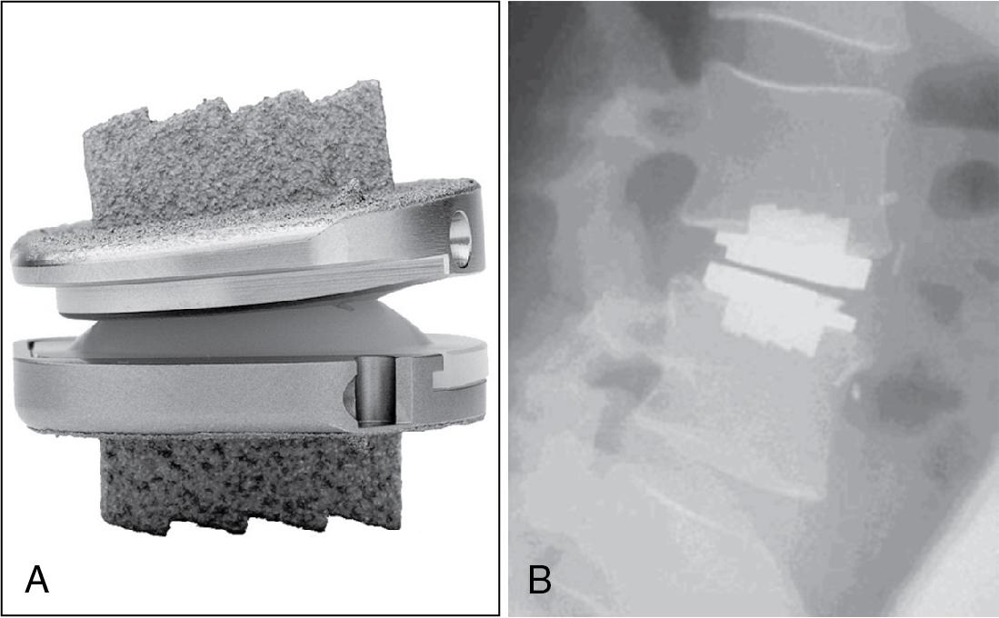 Fig. 32.1, The ProDisc-L artificial disc (Synthes Spine).