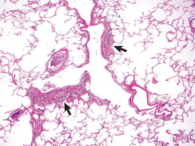 Fig. 61.1, Asbestos-induced peribronchiolar fibrosis. Histologic specimen shows thickening of airway wall (arrows) resulting from peribronchiolar fibrosis and pigmented dust.