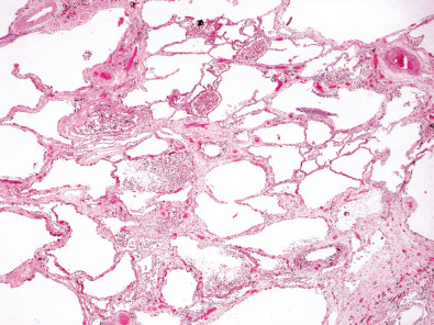 Fig. 61.2, Asbestosis. Low-power view shows diffuse fibrosis .