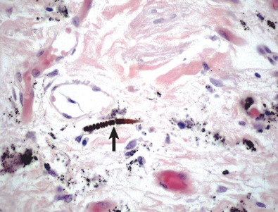 Fig. 61.3, Asbestos body. Pathologic specimen from same case as in Fig. 61.1 shows typical beaded appearance and gold color of asbestos body (arrow).