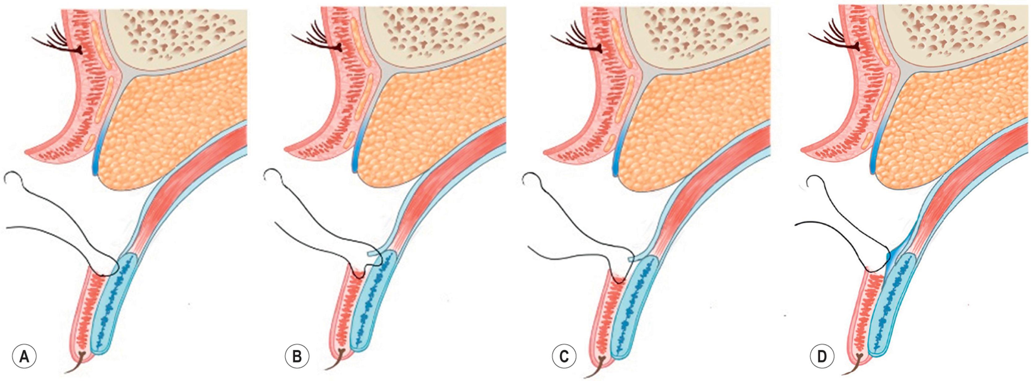 Figure 15.12, Various double fold fixation methods. (A) Tarsodermal fixation. (B) Tarsus–dermis–aponeurosis fixation. (C) Dermis–aponeurosis fixation. (D) Septo-aponeurotic junctional thickening fixation.