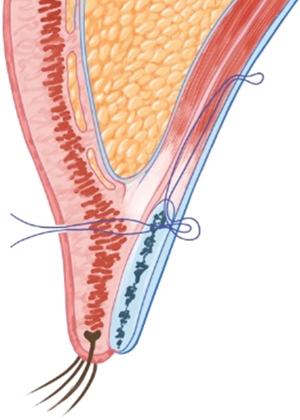 Figure 15.13, Anterior approach of non-incisional ptosis correction.