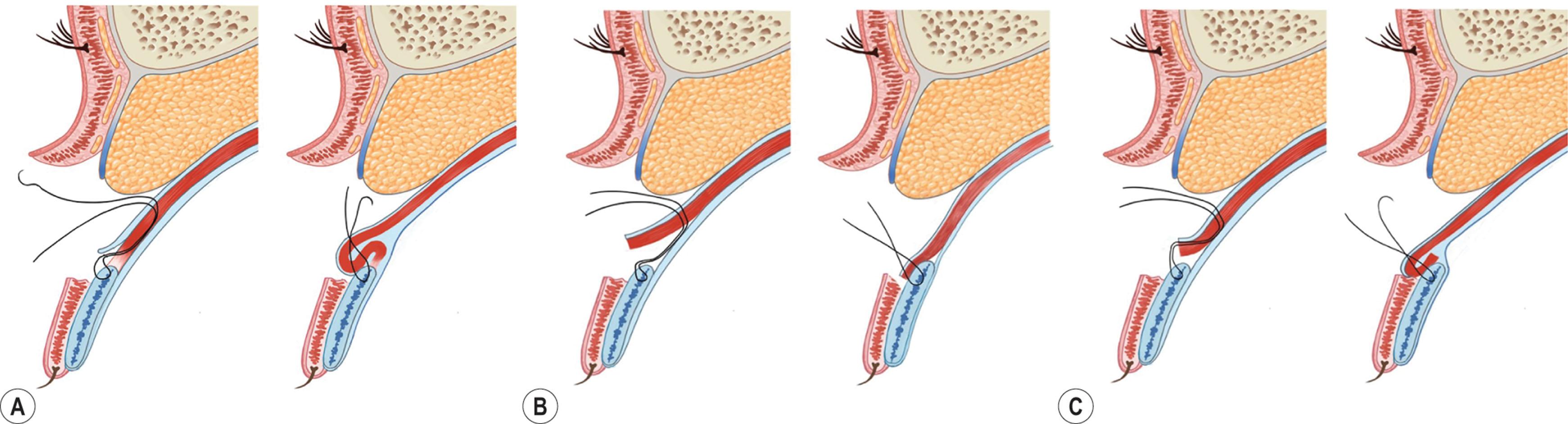 Figure 15.14, (A) Levator complex plication. The thread is passed between the Müller muscle and the conjunctiva with dissection between the levator aponeurosis and the tarsal plate but without dissection between the Müller muscle and the conjunctiva. The posterior levator complex is advanced, folded, and fixed to the tarsus. The adhesion established between the posterior part of the Müller muscle, the tarsal plate, and between the layers of Müller’s muscle itself is stronger. (B) Levator resection method: after dissection between the Müller muscle and the conjunctiva, the levator complex is pulled and fixed to the tarsal plate. Since the levator complex is advanced without folding, the mass effect is minimal. Therefore, use of the levator resection method is suitable in cases of severe ptosis requiring significant correction. (C) Combined levator complex plication and levator resection: the tarsus and levator complex are separated to slightly dissect between the Müller muscle and conjunctiva. Then, levator complex advancement is performed to reduce the mass effect.