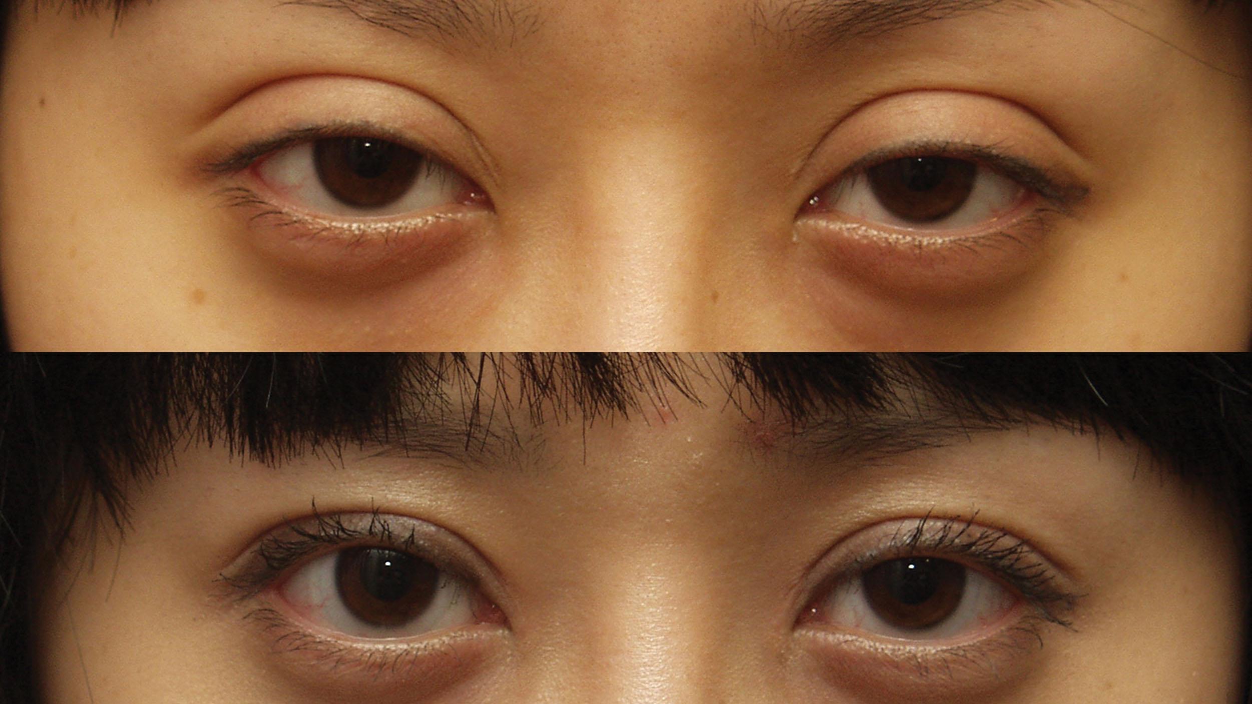 Figure 15.15, Photos before and after re-operation of a patient with a high double fold.