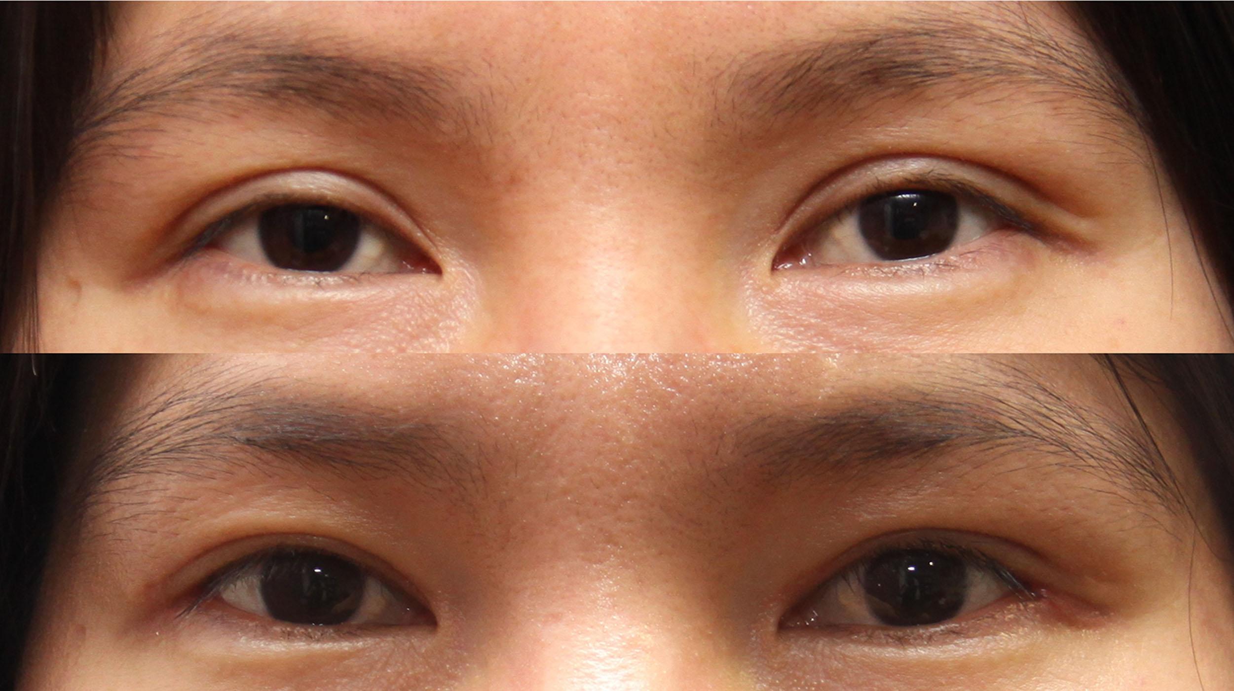 Figure 15.17, Photos before and after re-operation of a patient with double eyelid depth problem.