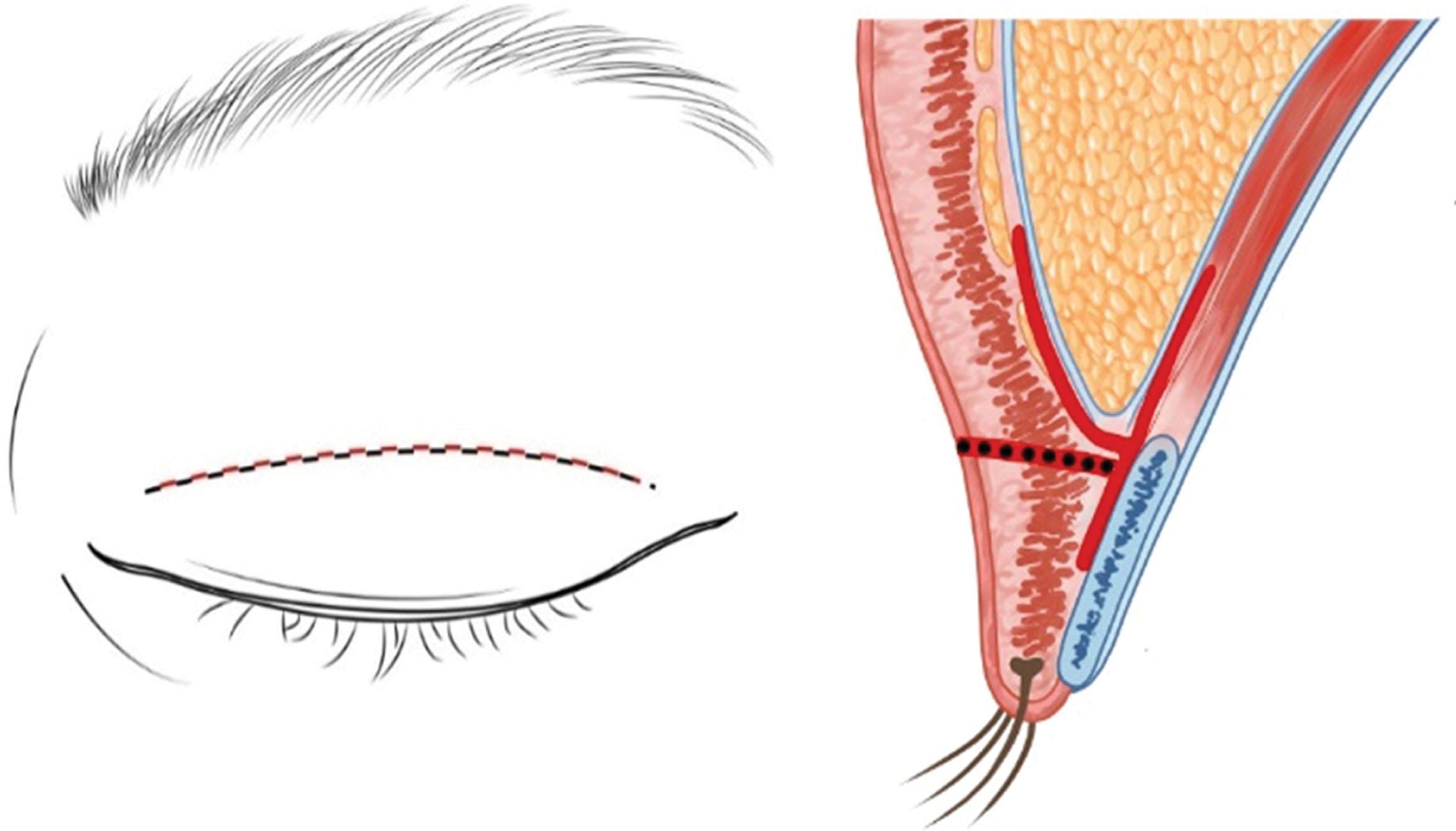 Figure 15.18, Depth problem. If the height is low but the depth is deep, an incision is applied along the existing scar to release the adhesion.