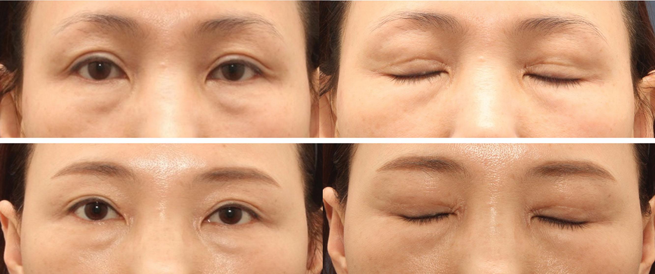 Figure 15.19, Photos before (above) and after (below) re-operation of a patient with double eyelid adhesion problem.