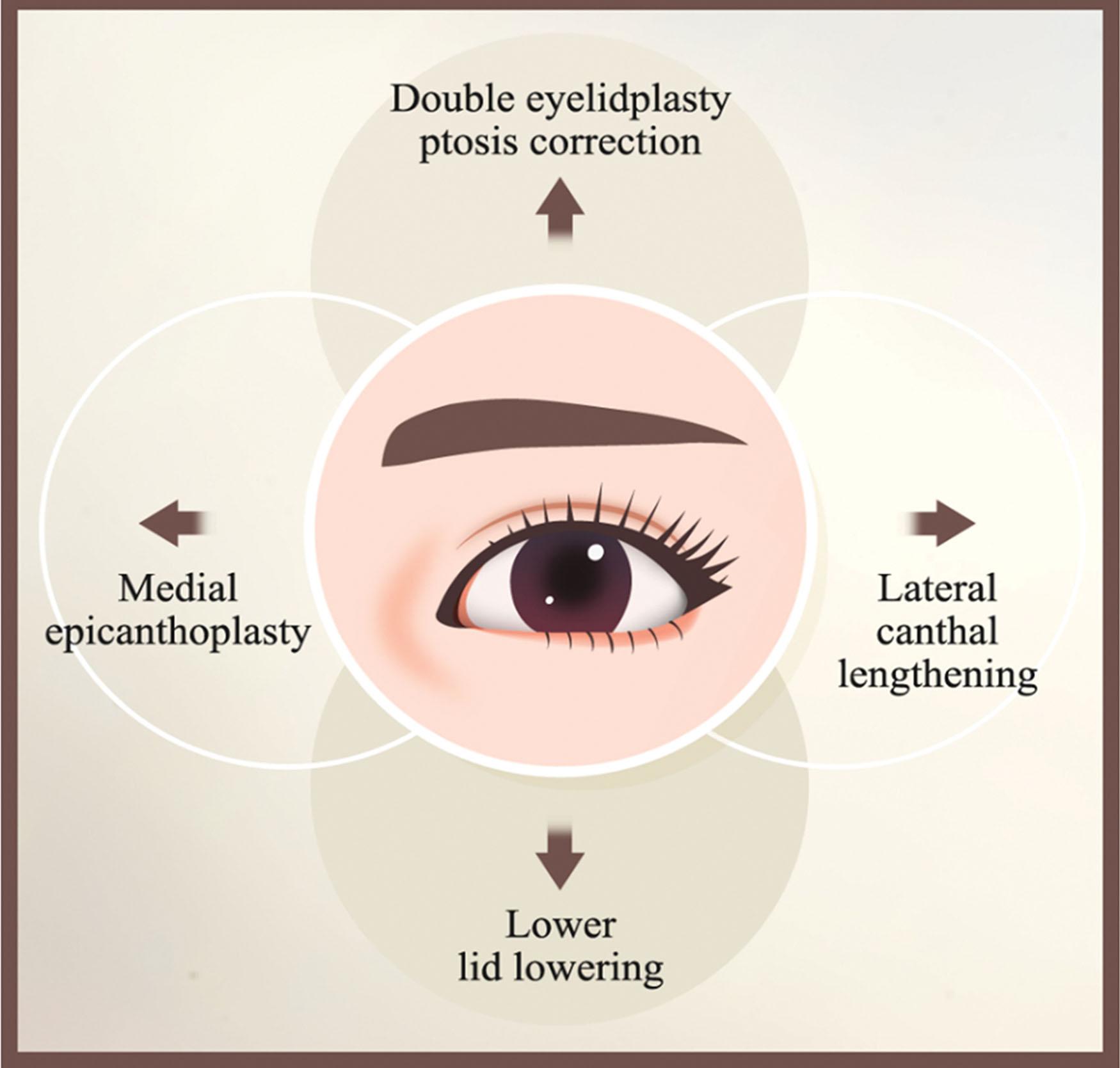 Figure 15.20, Four-directional extension of palpebral fissure.