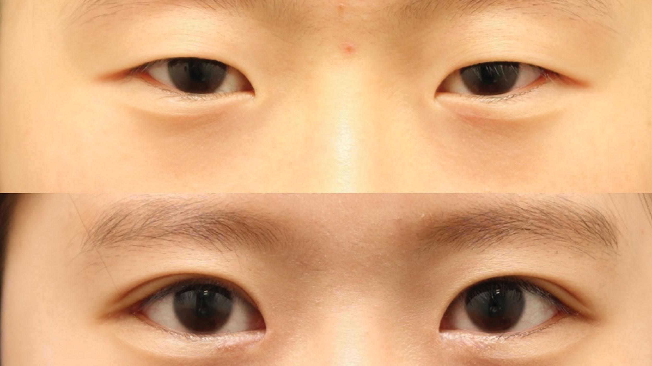 Figure 15.21, Preoperative and postoperative photographs of four-directional extension (incisional double-eyelidplasty with ptosis correction, medial epicanthoplasty, lateral canthal lengthening with canthal slant lowering).