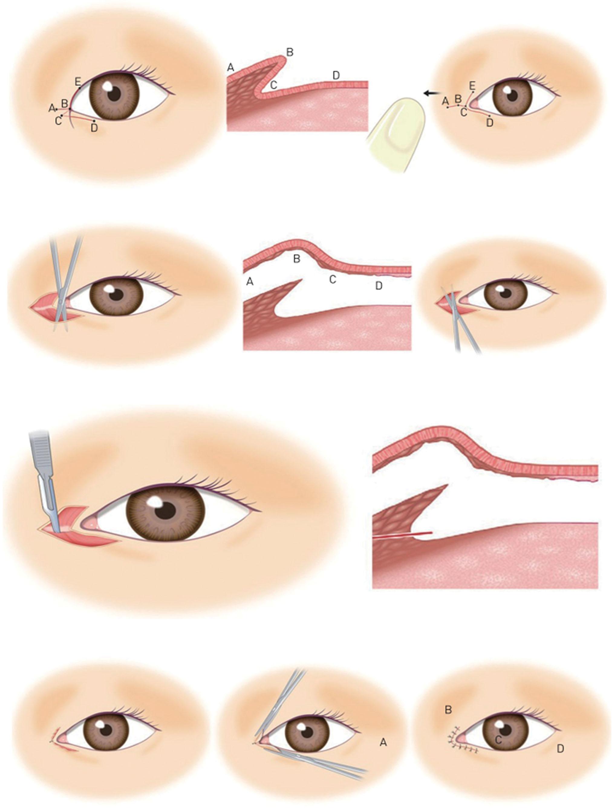 Figure 15.22, Modified skin-redraping medial epicanthoplaty.