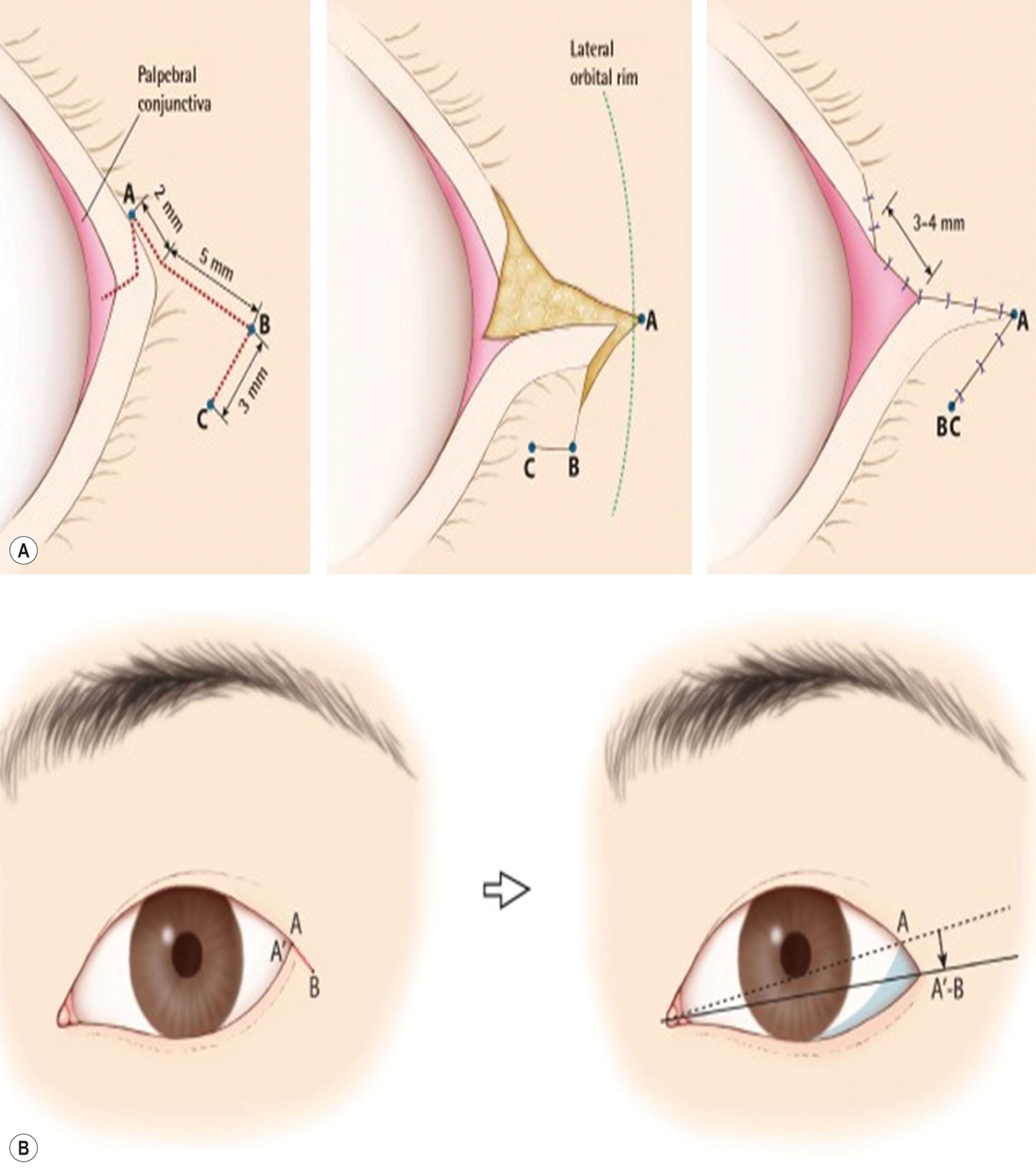 Figure 15.23, Various cosmetic lateral canthal lengthening methods. (A) Rotation flap method. (B) Lateral canthotomy method. (C) Canthal angle-preserving lateral canthotomy method.