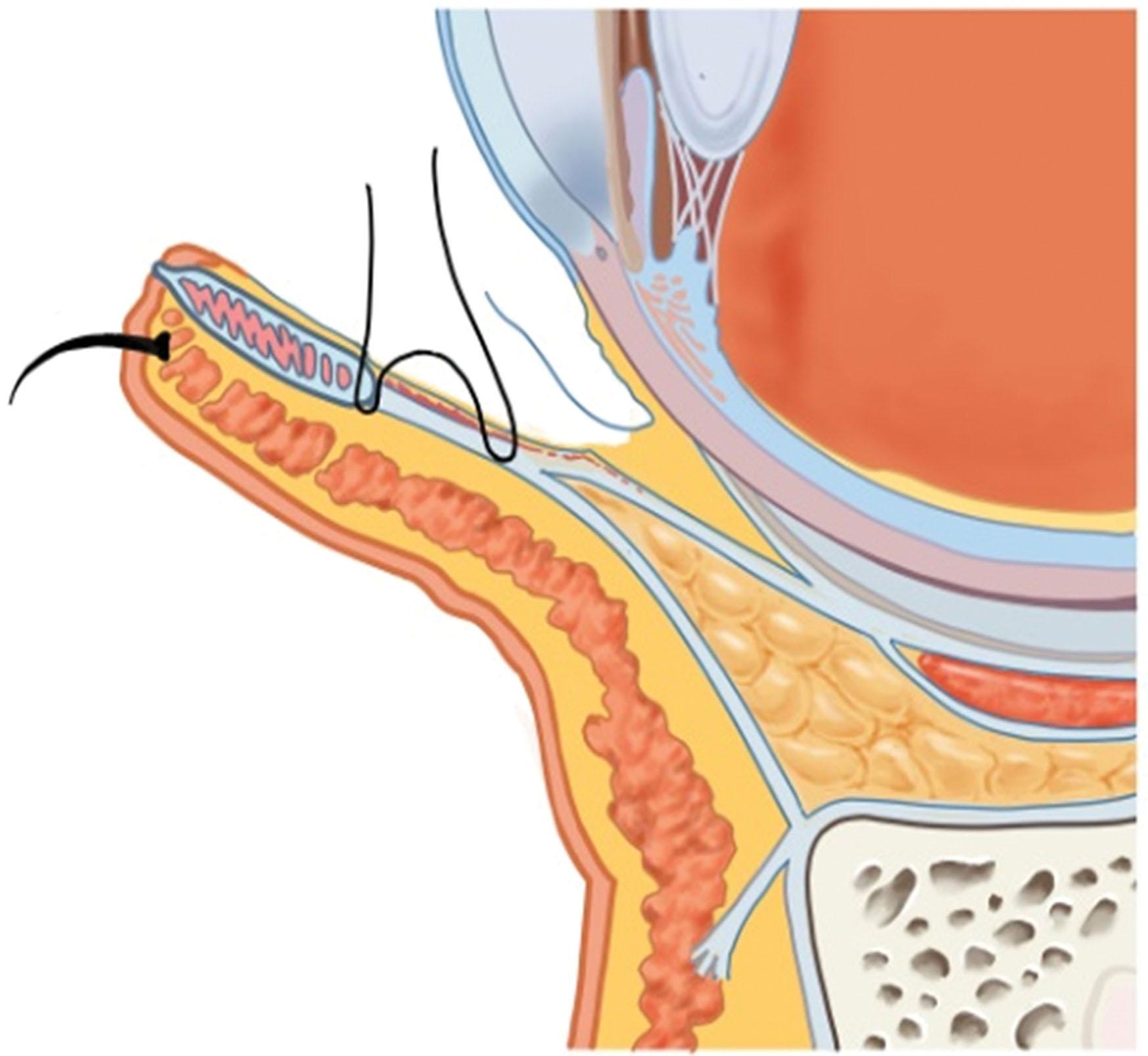 Figure 15.24, Lower lid lowering procedure.