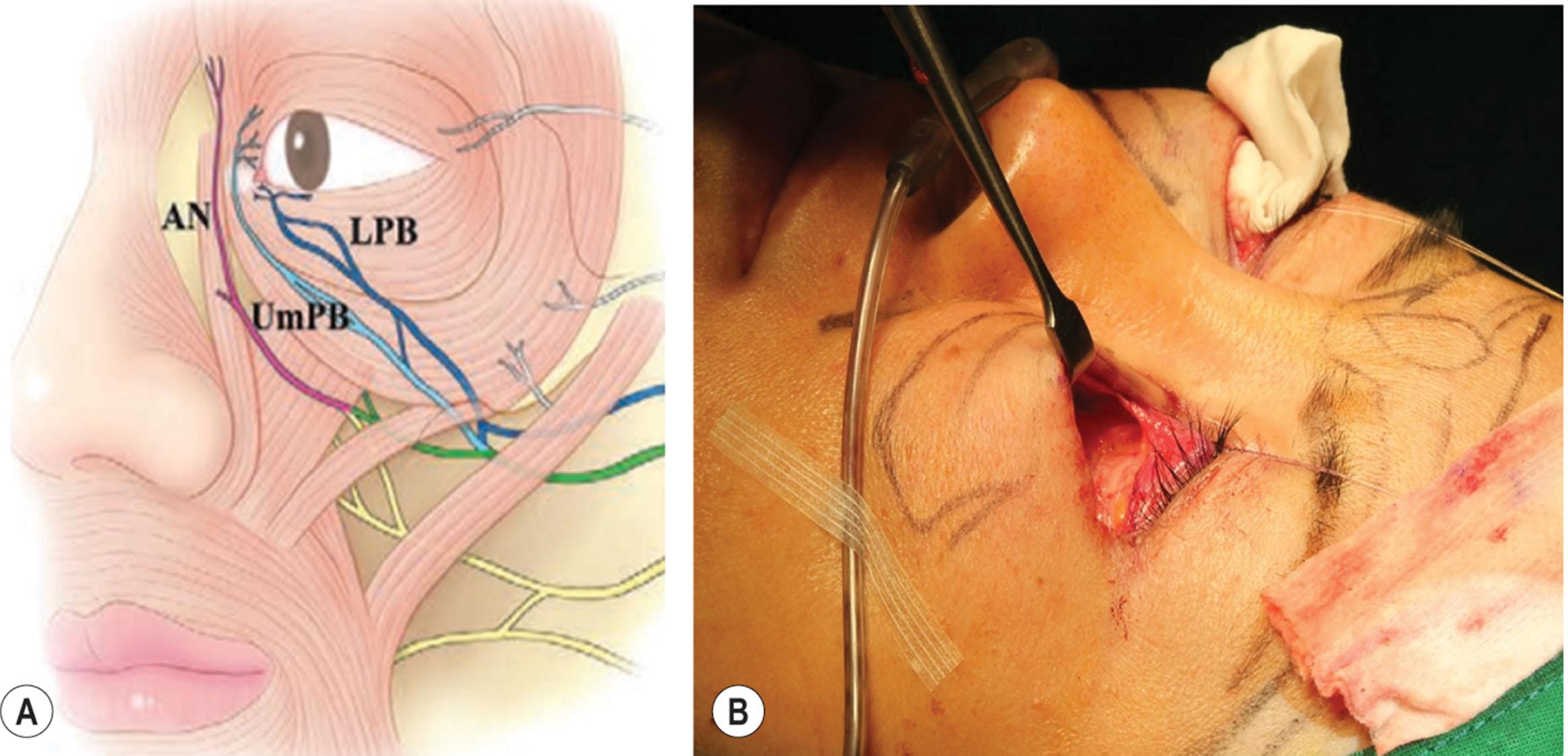 Figure 15.27, Preservation of medial orbicularis oculi muscle innervation. (A) Pathway of zygomatic nerve’s branch to medial OOM. AN , Angular nerve; LPB , lower palpebral branch; UmPB , upper medial palpebral branch. (B) Preservation of medial one-third of OOM during lower blepharoplasty.