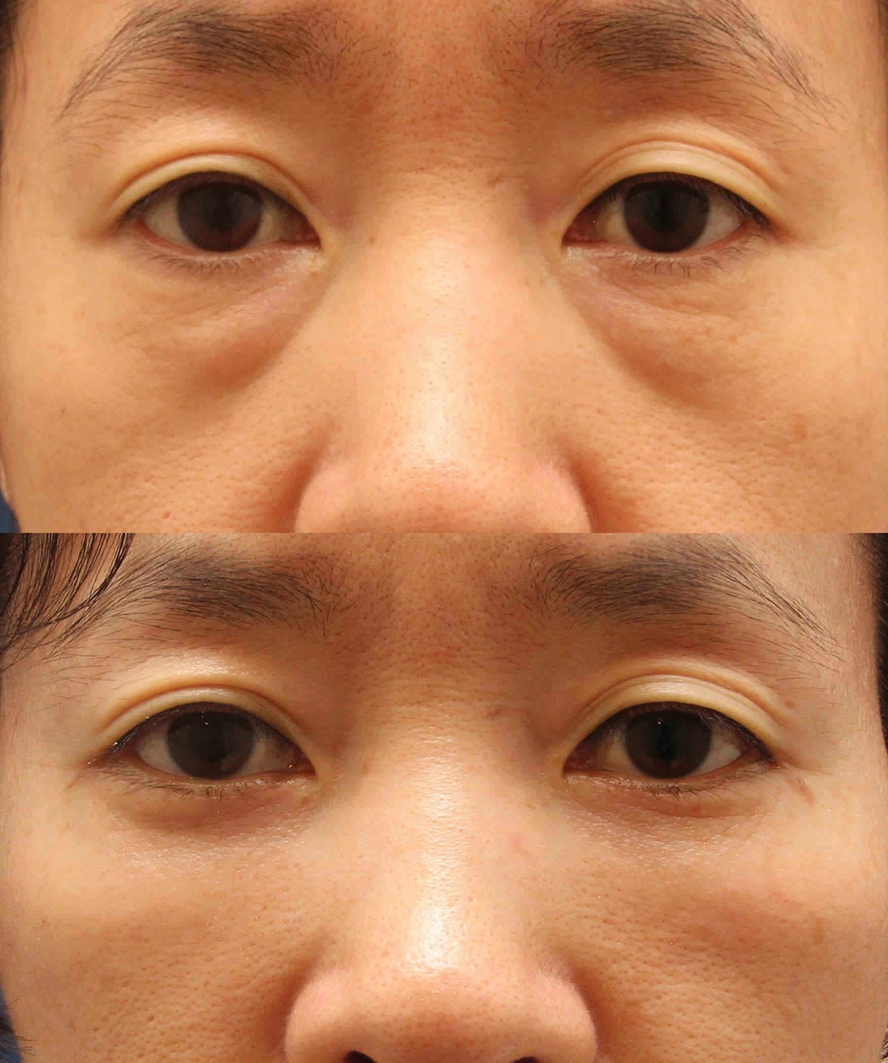 Figure 15.26, Preoperative and postoperative photos of lower blepharoplasty.