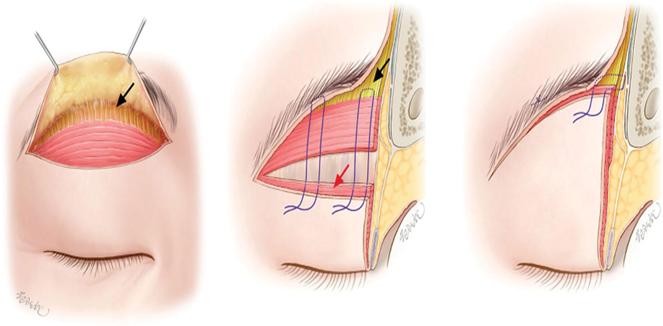 Figure 15.29, Picture of frontalis sling ﬁxation. From the lower ﬂap orbicularis oculi muscle stump margin, sutures were applied to the exposed frontalis muscle in several areas in a horizontal mattress fashion.