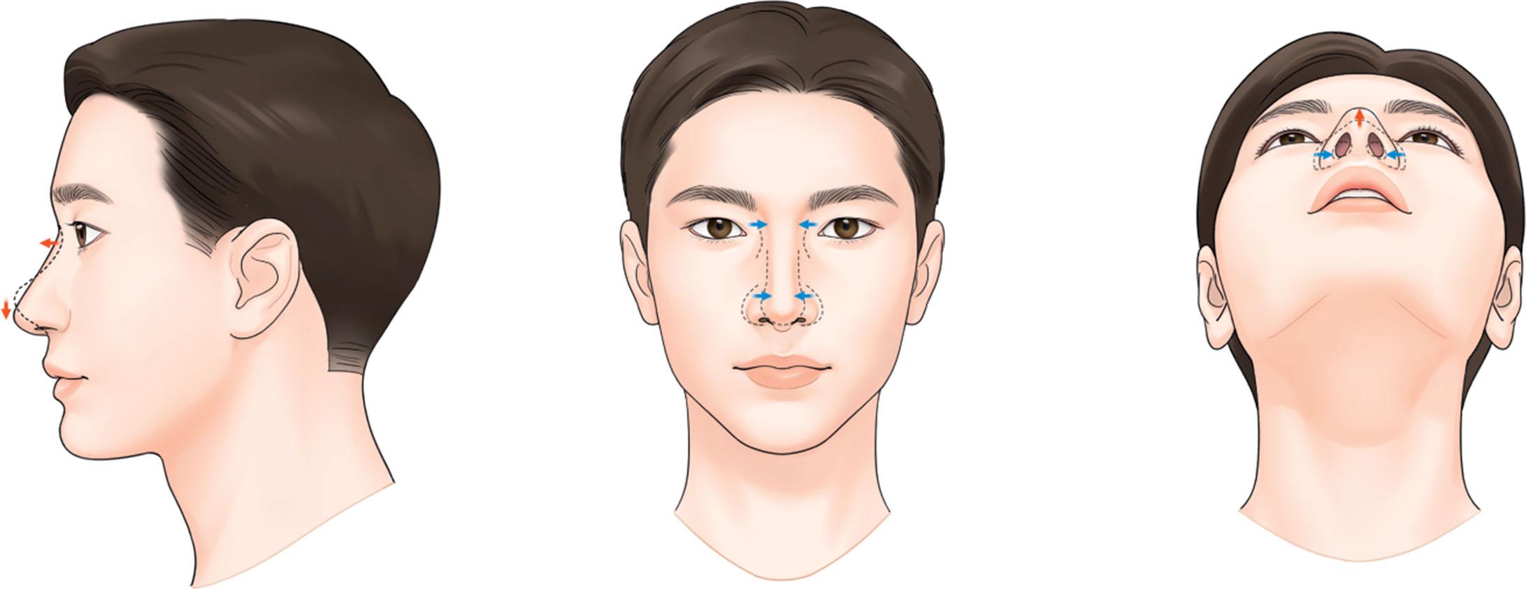 Figure 15.30, The common goals of Asian rhinoplasty include improving nasal tip projection, tip caudal rotation, and making more definite nasal dorsum lines while reducing not only the tip width, but also the alar width.