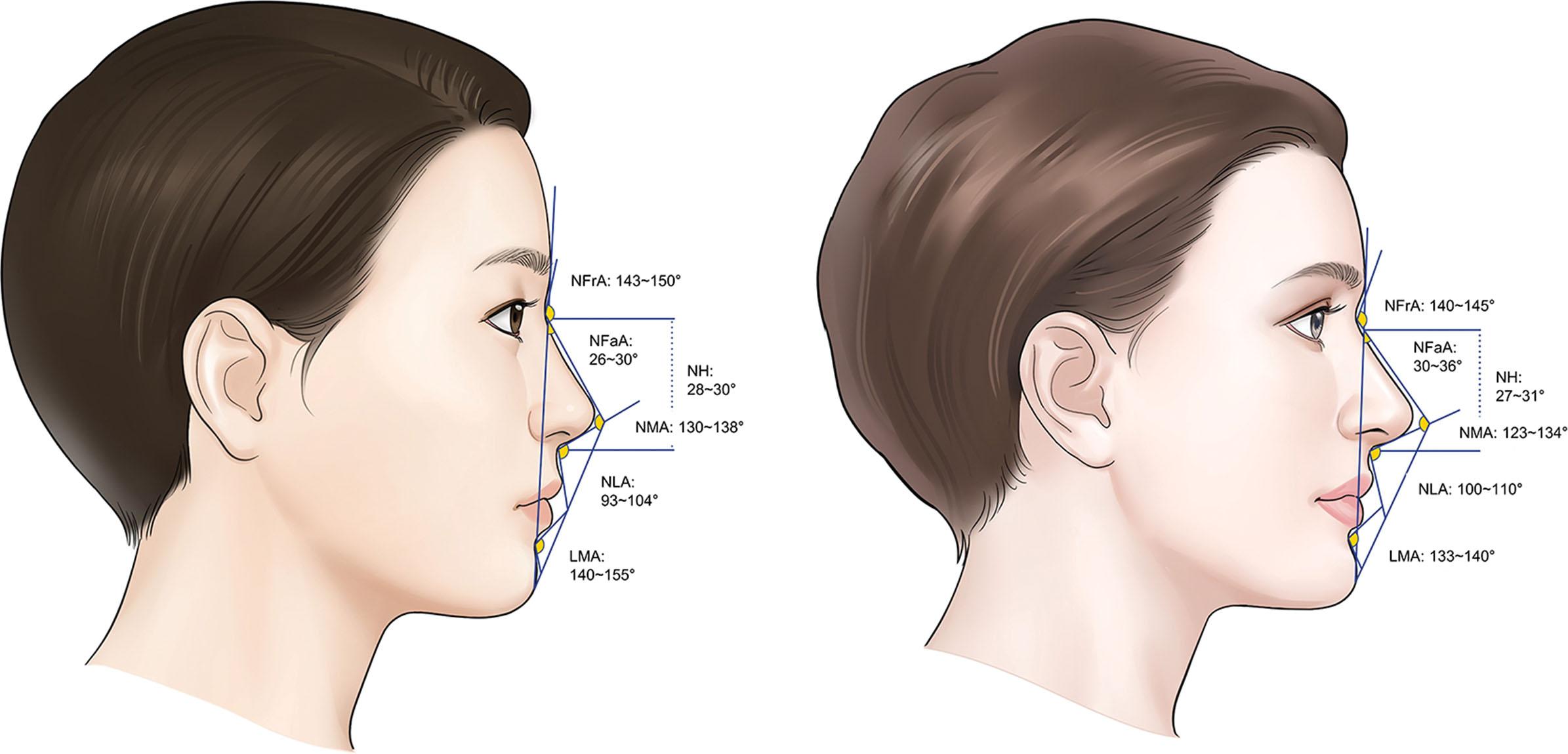 Figure 15.32, Ideal anthropometric angle and proportion reported in attractive Asian and Western women. LMA , Labiomental angle; NFA , nasofacial angle; NFrA , nasofrontal angle; NH , nasal height; NMA , nasomental angle.