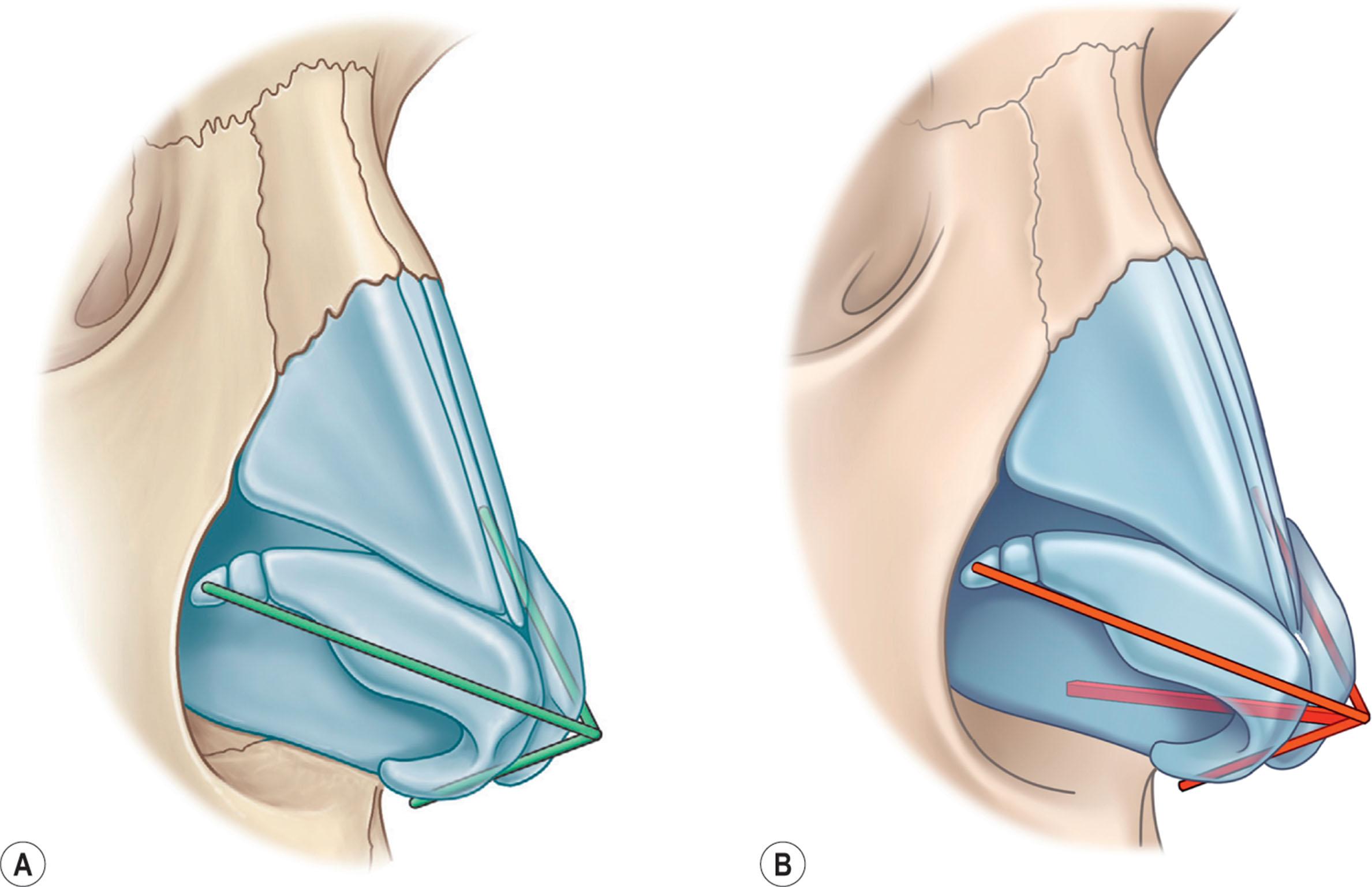 Figure 15.33, (A) Traditional nasal tip tripod theory suggested by Anderson in the 1960s. (B) Contemporary Asian nasal tip quadripod concept based on the septum as a major supporting structure.