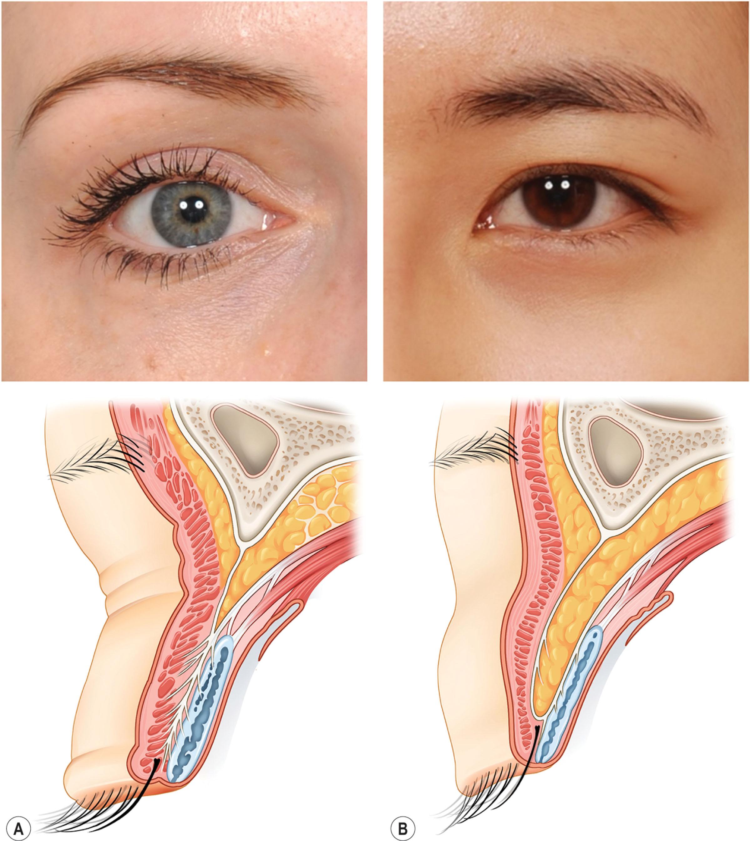 Figure 15.5, (A) The differences in skeleton and levator attachment make Oriental eyes look different (B) . Multiple theories exist regarding the formation of the supratarsal crease or fold. First theory: expansions of the levator palpebrae superioris muscle penetrating through the septum and orbicularis oculi muscle to the overlying dermis were thought to be more present in Caucasian eyelids. Second theory: supratarsal crease formation is the level of fusion of the orbital septa and the levator aponeurosis. The level of adhesion defines the superior palpebral crease in most Caucasian eyelids, whereas lower fusions results in a low-lying or absent crease in the Asian eyelid. Third theory: the skeletal differences cause eyelid differences.