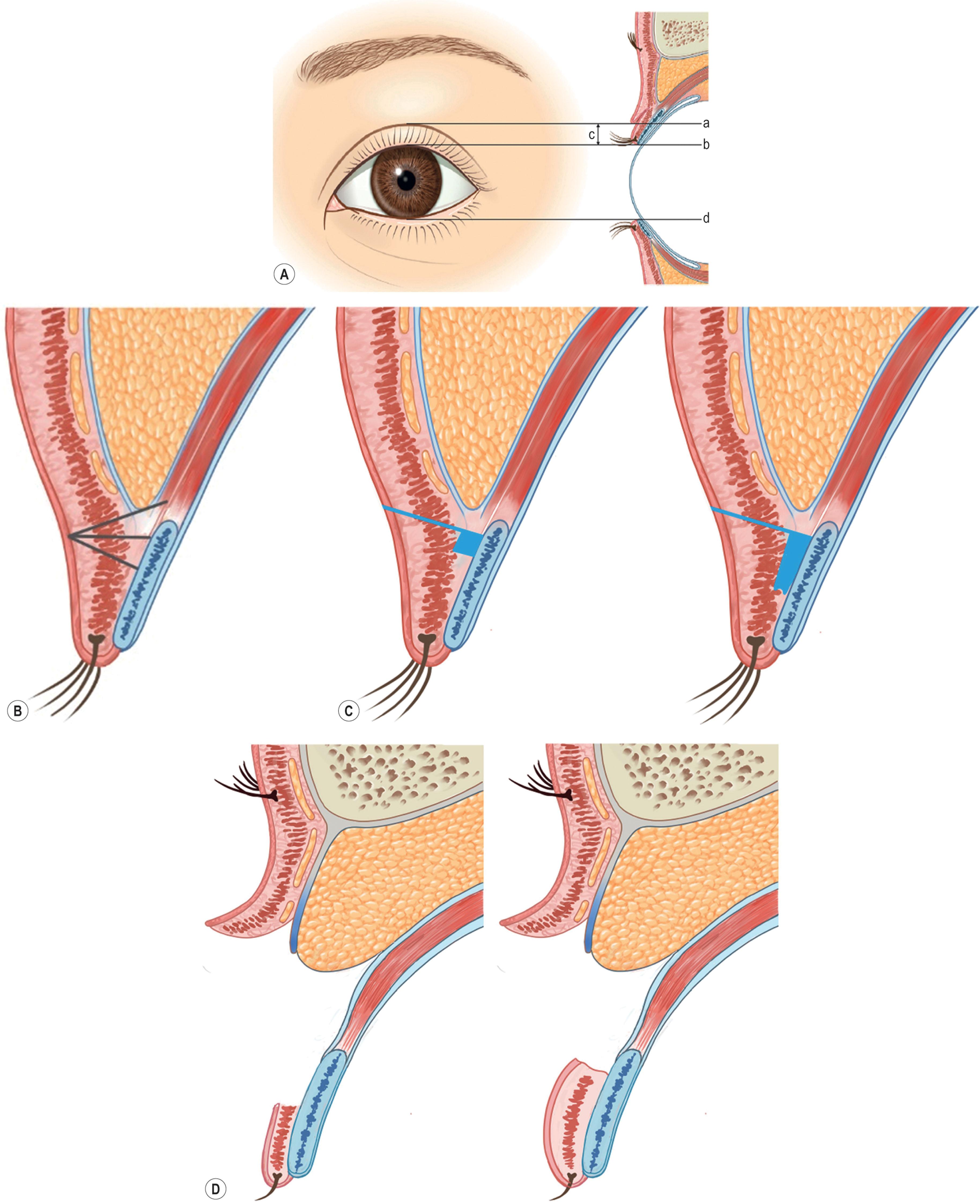 Figure 15.6, Five important factors that should be considered for making natural double fold. (A) Height: a , double eyelid line, lower border of fold; b , upper lid margin; c . pretarsal exposure; d , lower lid margin. (B) Depth: the black line represents the fixed anterior lamellar height. Higher heights indicate longer lines and deeper double folds. (C) Adhesion: depending on the degree of removal of the pretarsal soft tissue, a linear adhesion (left) and a planar adhesion (right) are formed. (D) Volume, which is proportional to the height.