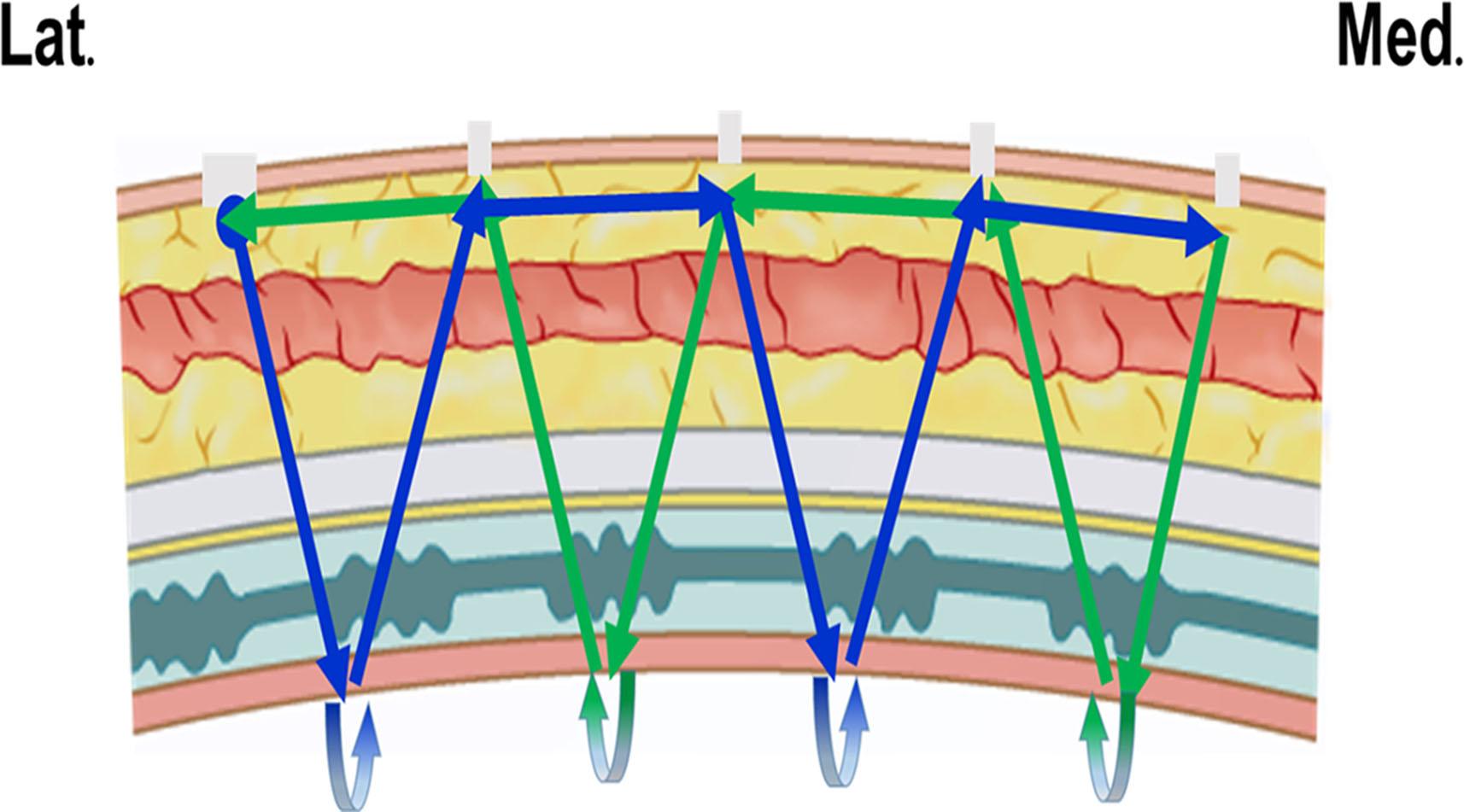 Figure 15.9, Single-stitch continuous buried method. The stitch is simply inserted through the skin at the level of the preferred lid crease, traversing the full thickness of the lid tissues down to and including either the levator aponeurosis or the tarsal plate. Lat ., Lateral; Med ., medial.