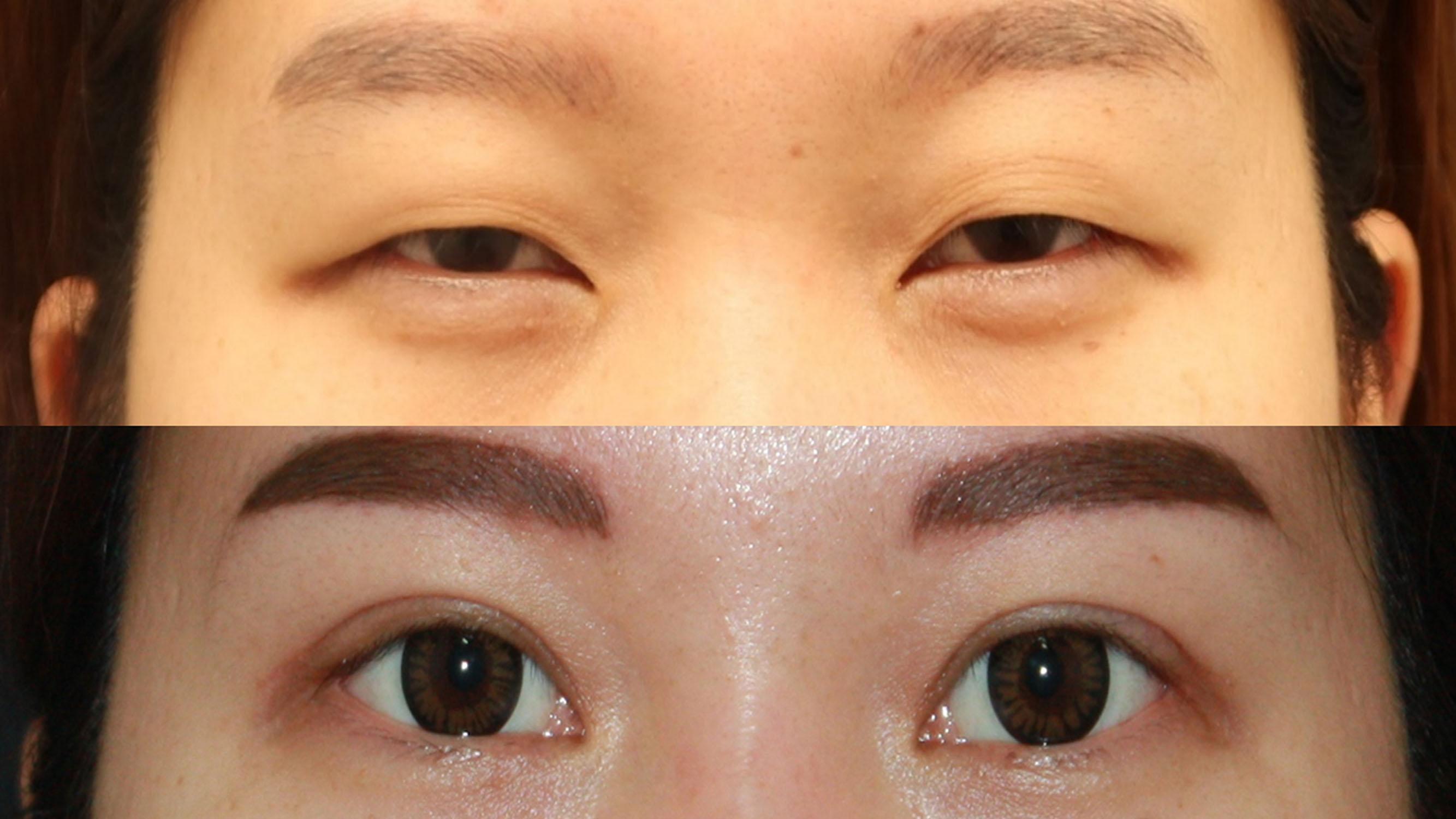 Figure 15.10, Preoperative and postoperative photos of incisional double blepharoplasty.