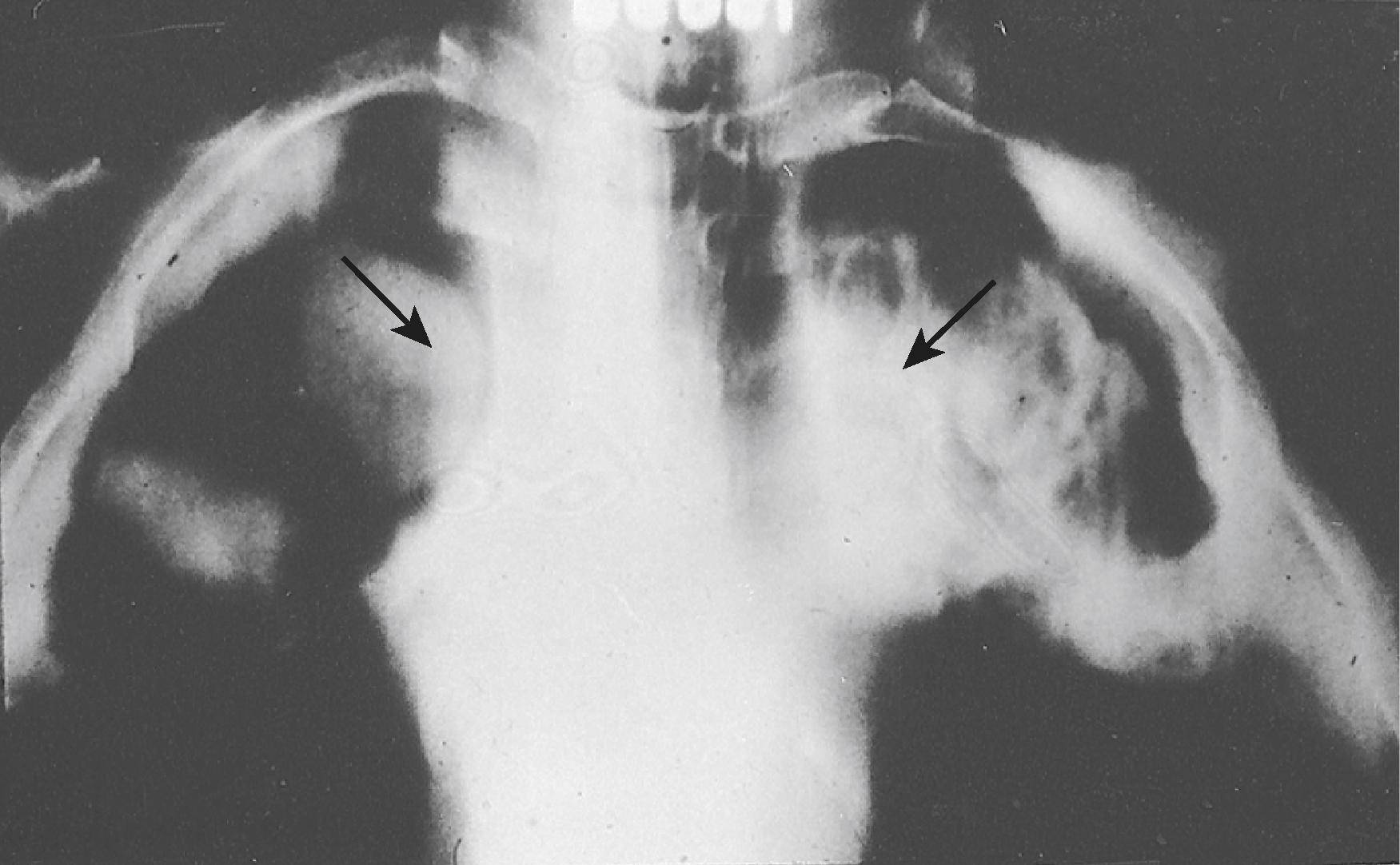 FIGURE 311-1, Tomogram of pulmonary aspergillomas ( arrows ).