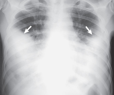 Fig. 64.1, Acute aspiration pneumonia in an alcoholic man. Anteroposterior chest radiograph shows extensive middle and lower lung zone–predominant consolidation (arrows).