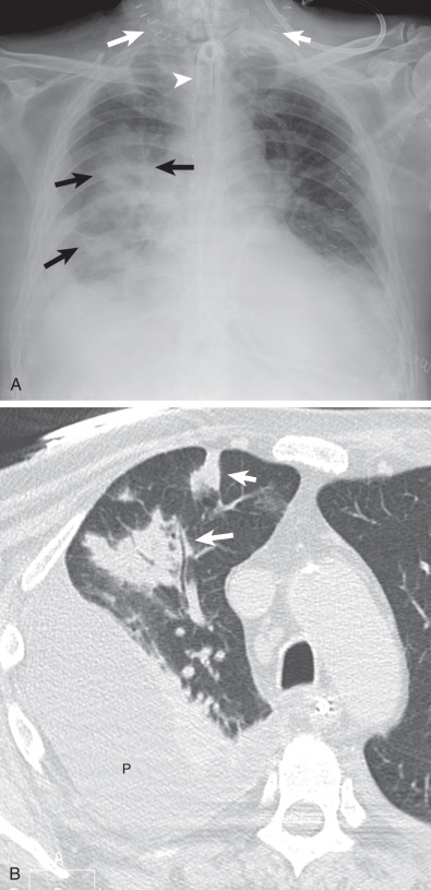 Fig. 64.2, Acute aspiration pneumonia after neck surgery. (A) Anteroposterior chest radiograph shows extensive right lung consolidation (black arrows) and right pleural effusion. Note postsurgical metallic staples (white arrows) and tracheostomy tube (arrowhead). (B) Corresponding CT shows multifocal areas of consolidation (arrows) in the right upper lobe. A large pleural effusion (P) is also seen.